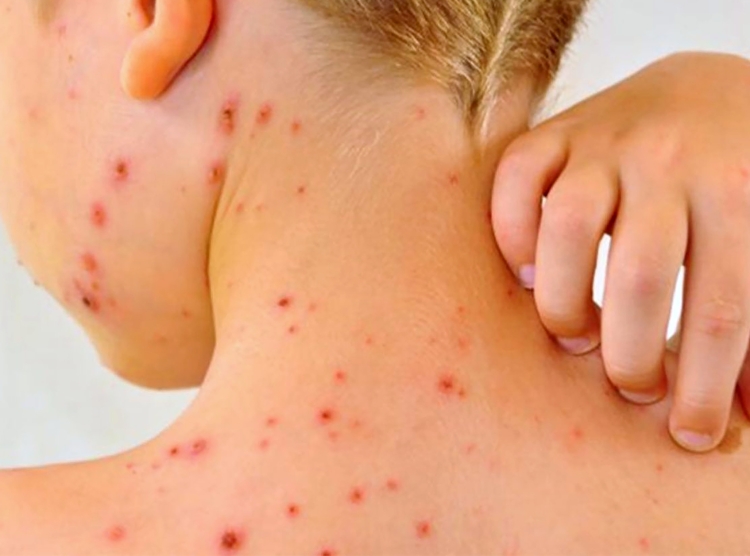 Suman 29 muertes por Sarampion tras confirmarse primer fallecimiento en Chiapas en 2025